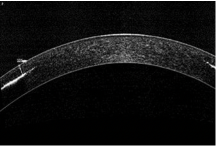 Fig. 3. Optical coherence tomography pachymetry 8 months after the procedure.