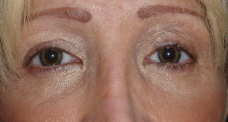 Aesthetic annular keratopigmentation: postoperative aspect