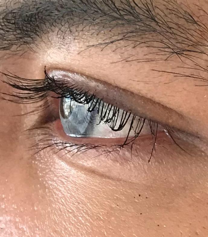Augenpflege-nach-Keratopigmentierung
